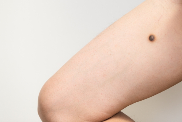 いぼ・ほくろとは?